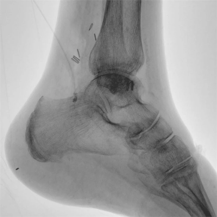 Hosital Raidology C Arm X-ray Machine