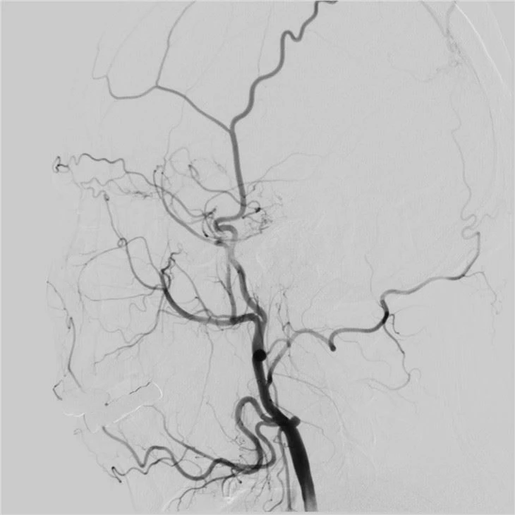 Hospital Use Medical Digital Subtraction Angiography System